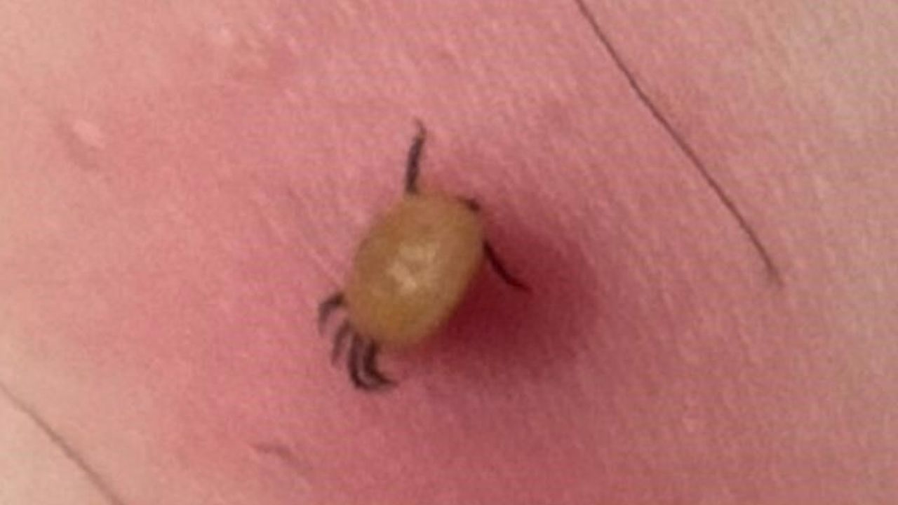 Kene ısırığı sonrası oluşan halka şeklindeki kızarıklık Lyme hastalığı belirtisi olabilir