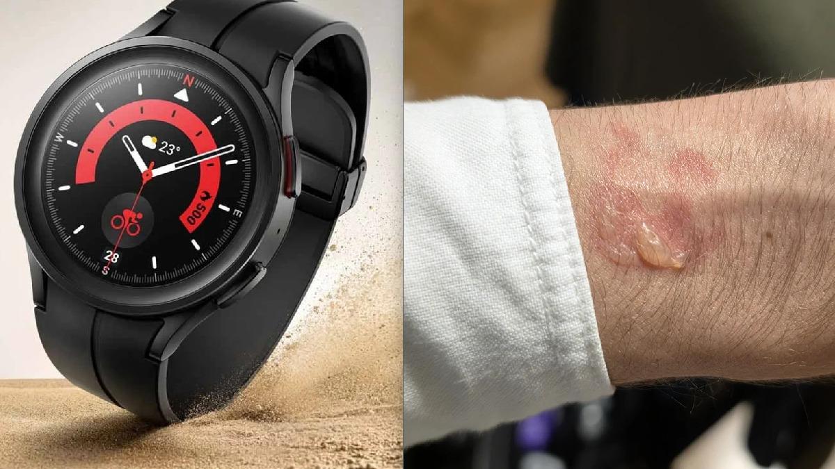 Samsung Galaxy Watch kullanıcıları bileklerinde yanık benzeri izler bildirdi
